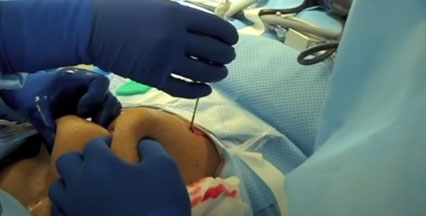 Picture of pneumoperitoneum needle in laparoscopic surgery