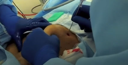 Picture of pneumoperitoneum needle in laparoscopic surgery